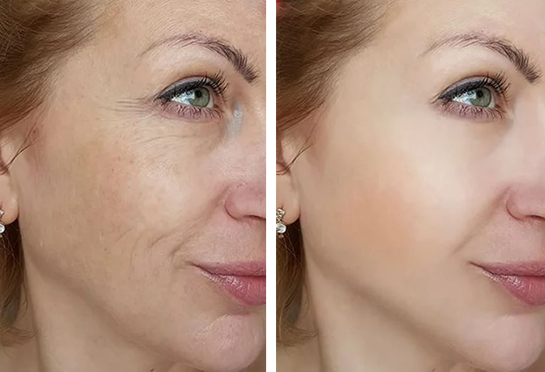Firmer, lifted skin after treatment